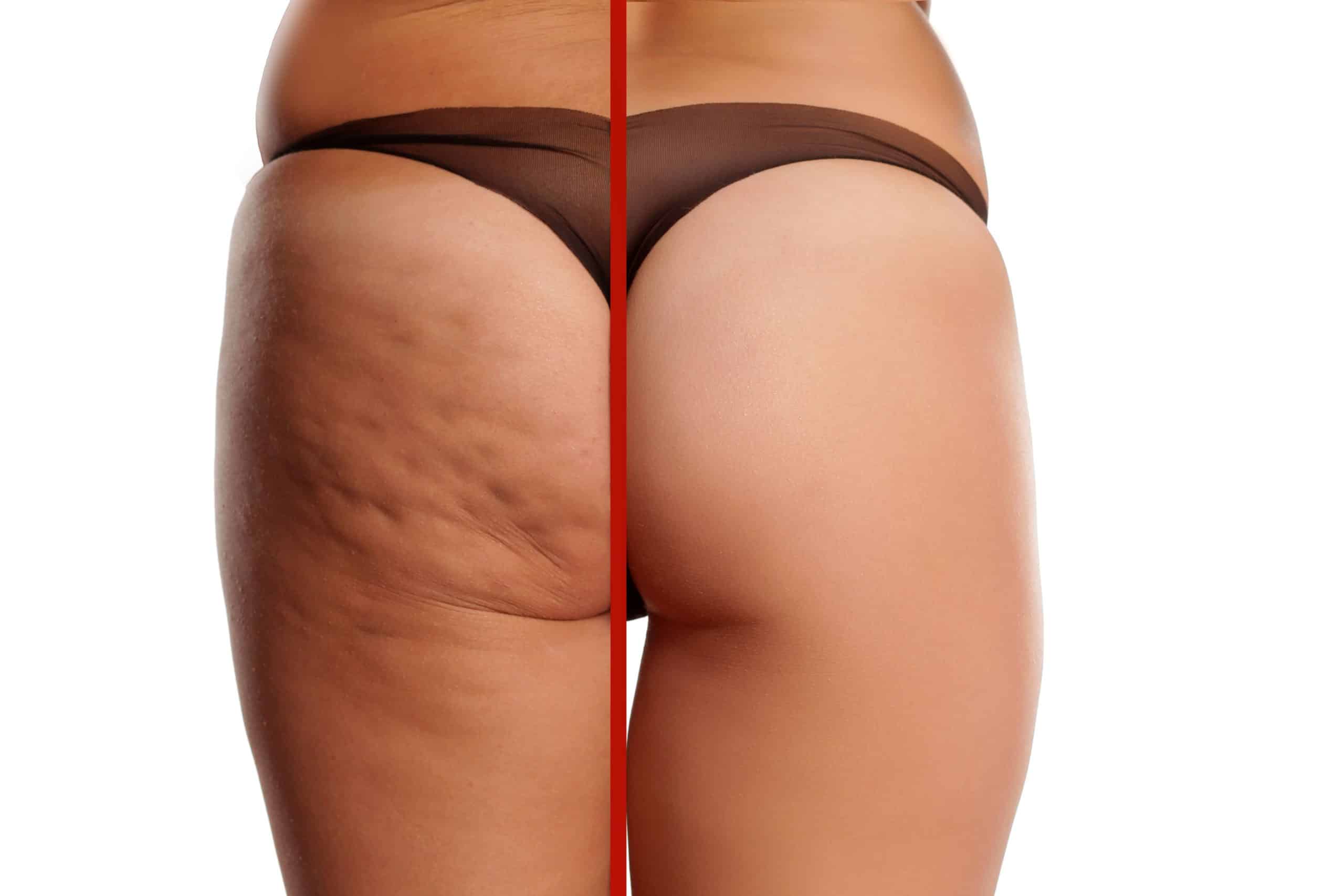 QWO Cellulite Treatment Before & After | Movel Medical Aesthetics in Brentwood, CA