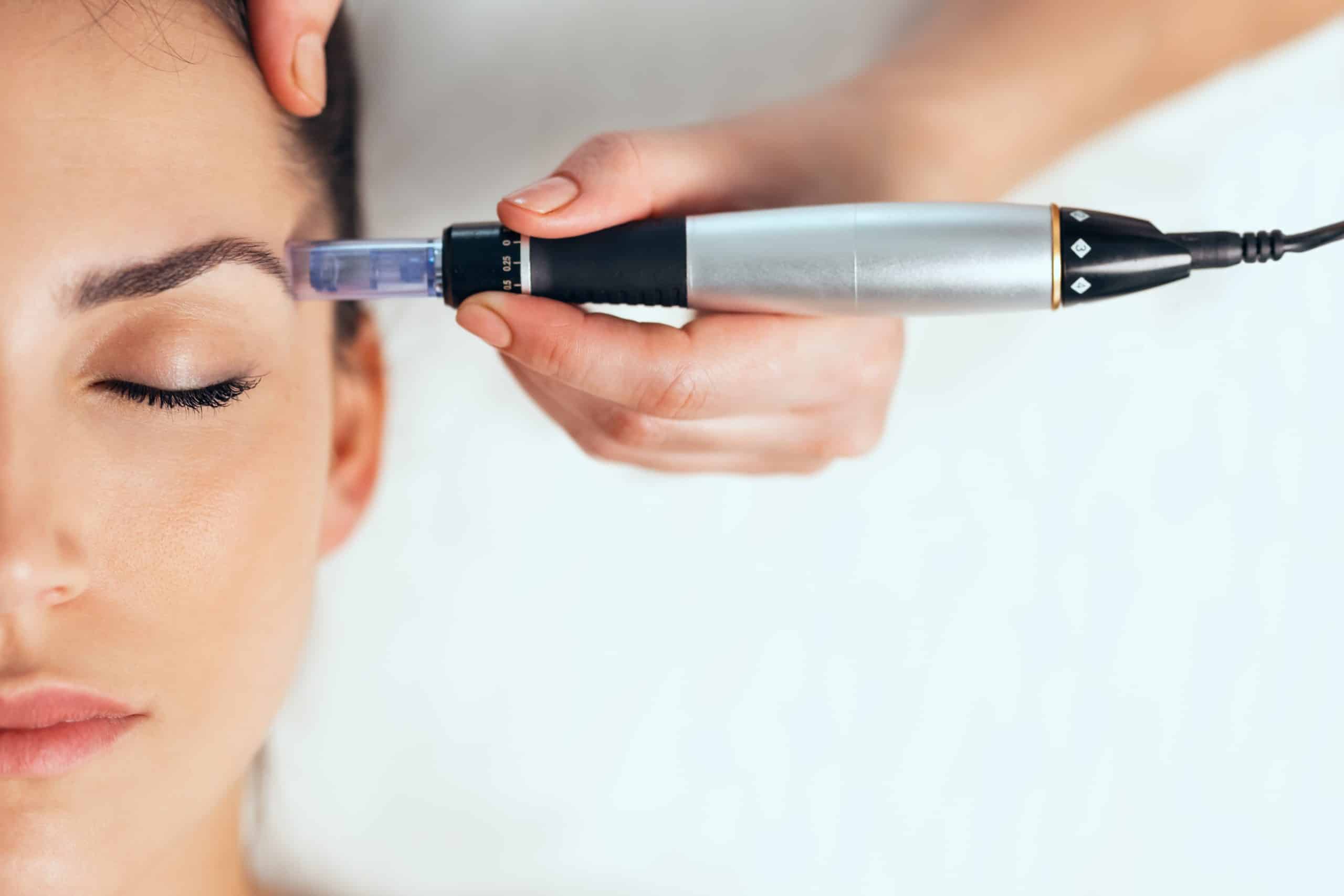 7 Reasons Microneedling Is So Beneficial for Your Skin